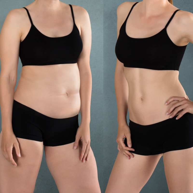Does Fat Freezing at Home Work? DIY Devices vs Professional Cryolipolysis 2 before and after Cryolipolysis Thame