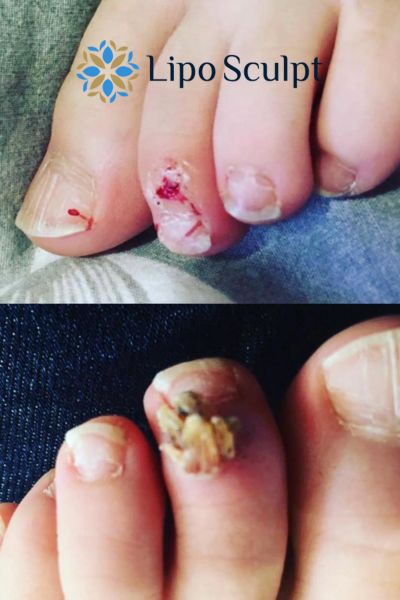 Wart removal customer results from Lipo Sculpt Thame